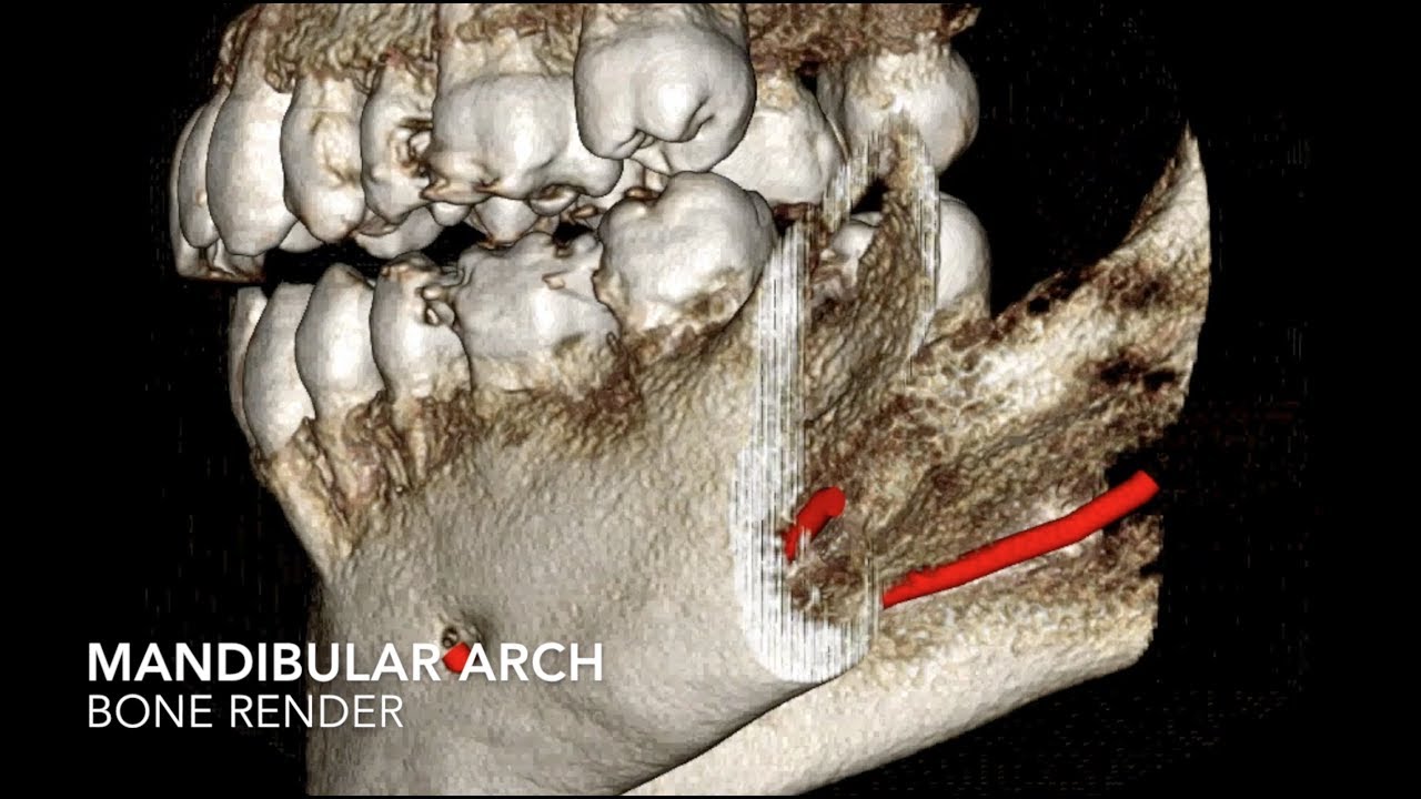 Here's what a 3D xray looks like! (Cone Beam CT)