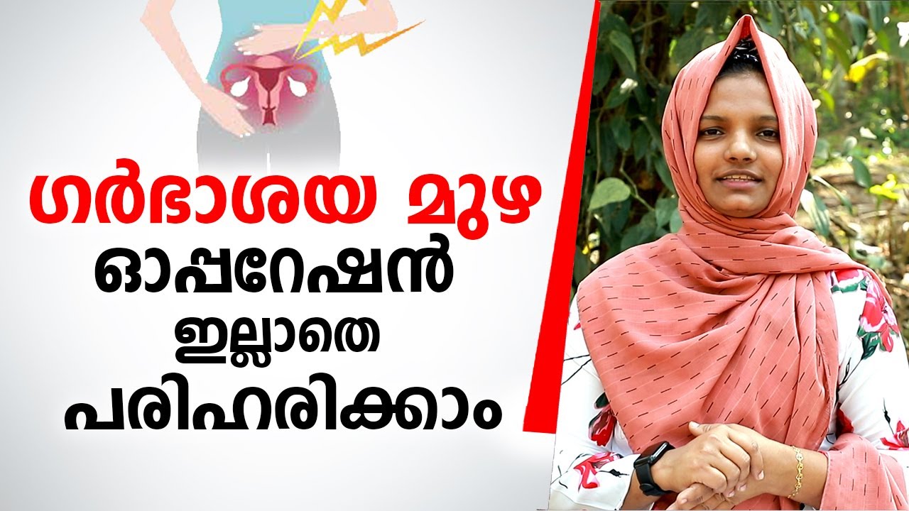 ഗർഭാശയ മുഴ ഓപ്പറേഷൻ ഇല്ലാതെ  പരിഹരിക്കാം | Fibroid Treatment without Operation