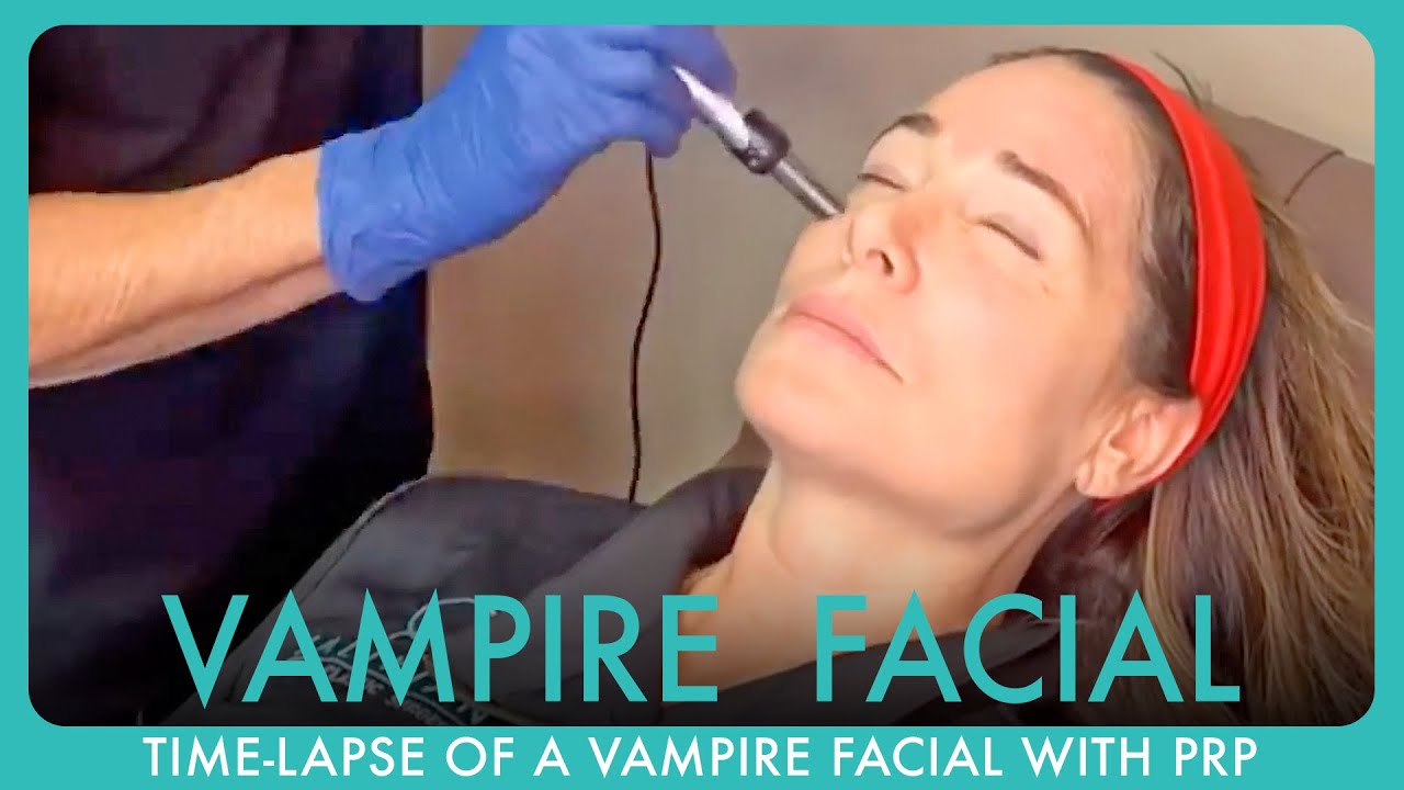 Time-Lapse of a Vampire Facial with PRP