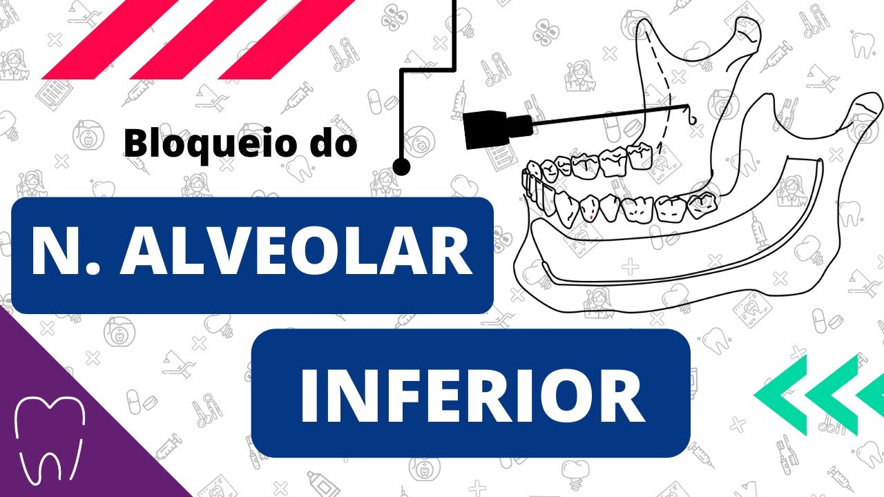 ANESTESIA MANDIBULAR | RESUMO MALAMED
