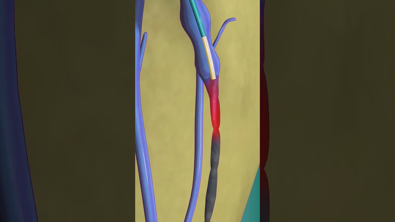 Using a laser to zap the varicose veins (3D Animation) #medical3danimation