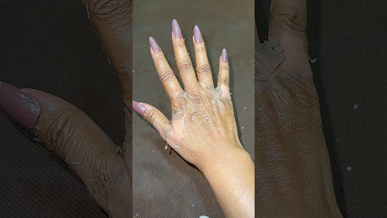 Chemical Peel On knees And  Hands #clearstemskincare #ytshorts #sristydutta