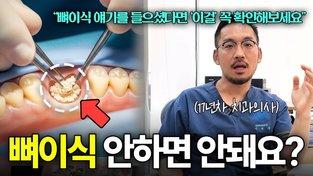 임플란트 뼈이식 | 치과의사마다 다른 얘기 하는 이유, 뼈이식 비용 | 실제 임상 다 알려드립니다.