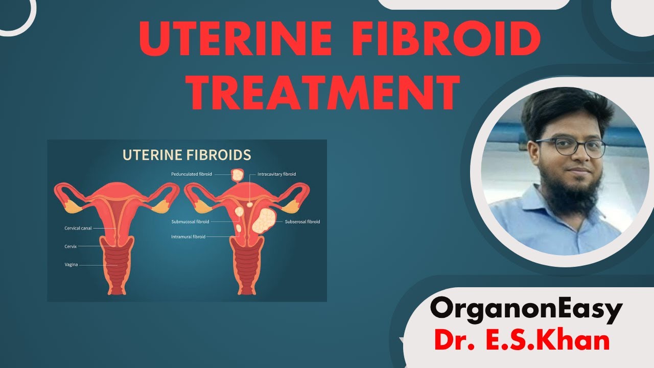 Uterine Fibroid | Dr. E.S.Khan | OrganonEasy