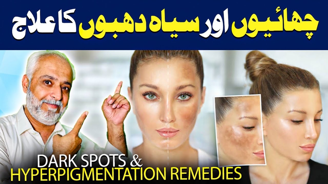 How To Get Rid Of Hyperpigmentation On Face Naturally | Hyperpigmentation Home Remedies
