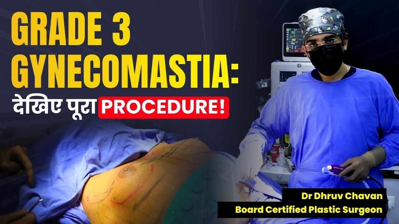 Grade 3 Gynecomastia Surgery: Step by Step Marking और Treatment Explained! | Dr DC, Pune
