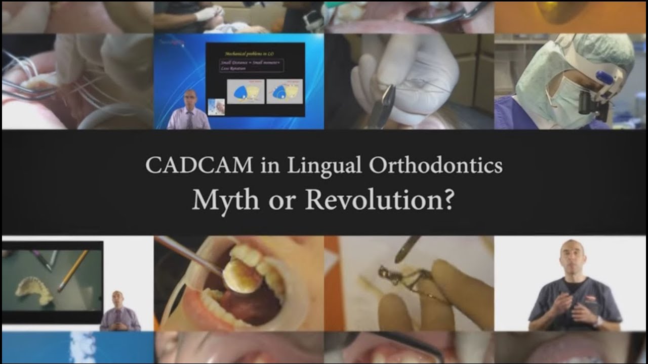 Dr. Rafi Romano - CADCAM in Lingual Orthodontics - Myth or Revolution?