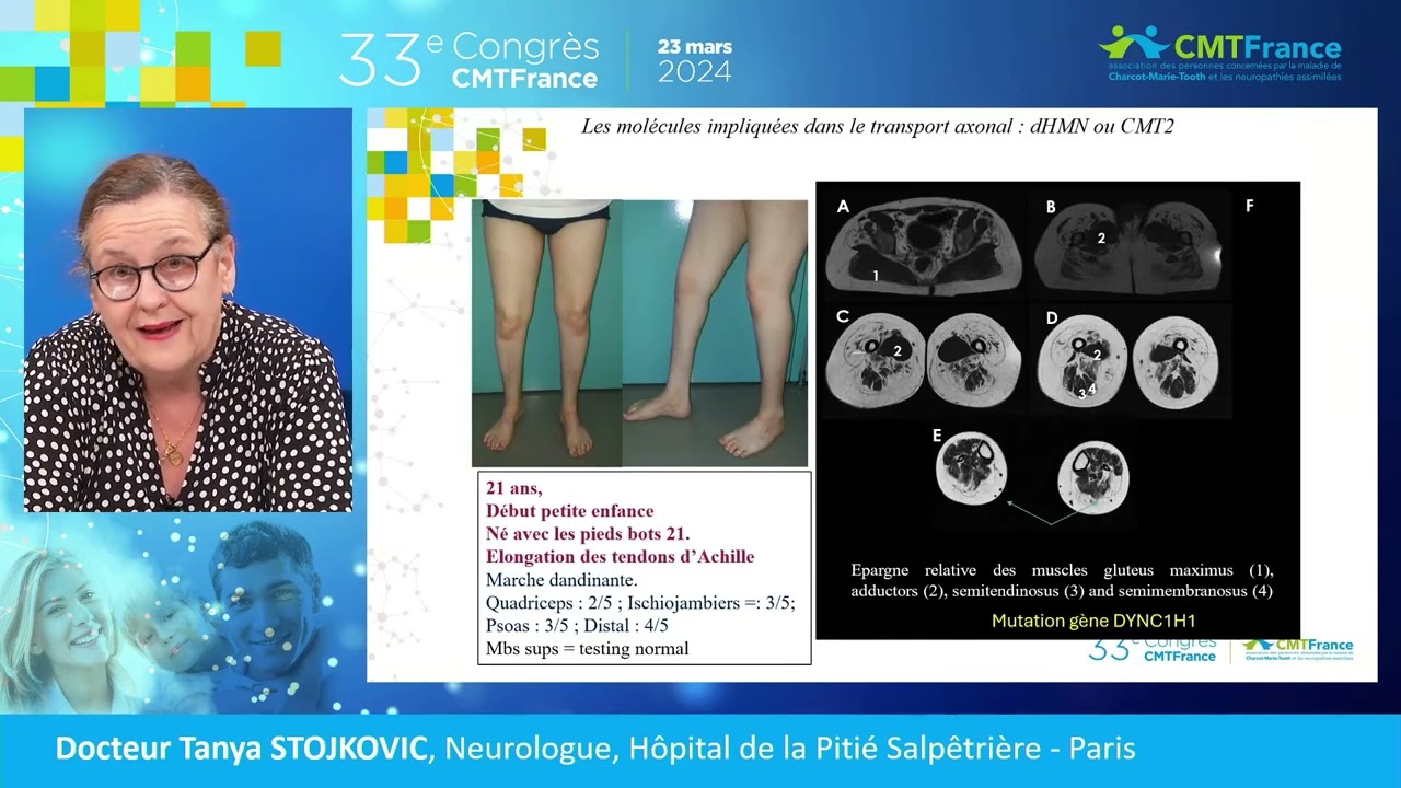 SESSION 4 Charcot Marie Tooth une maladie aux multiples facette