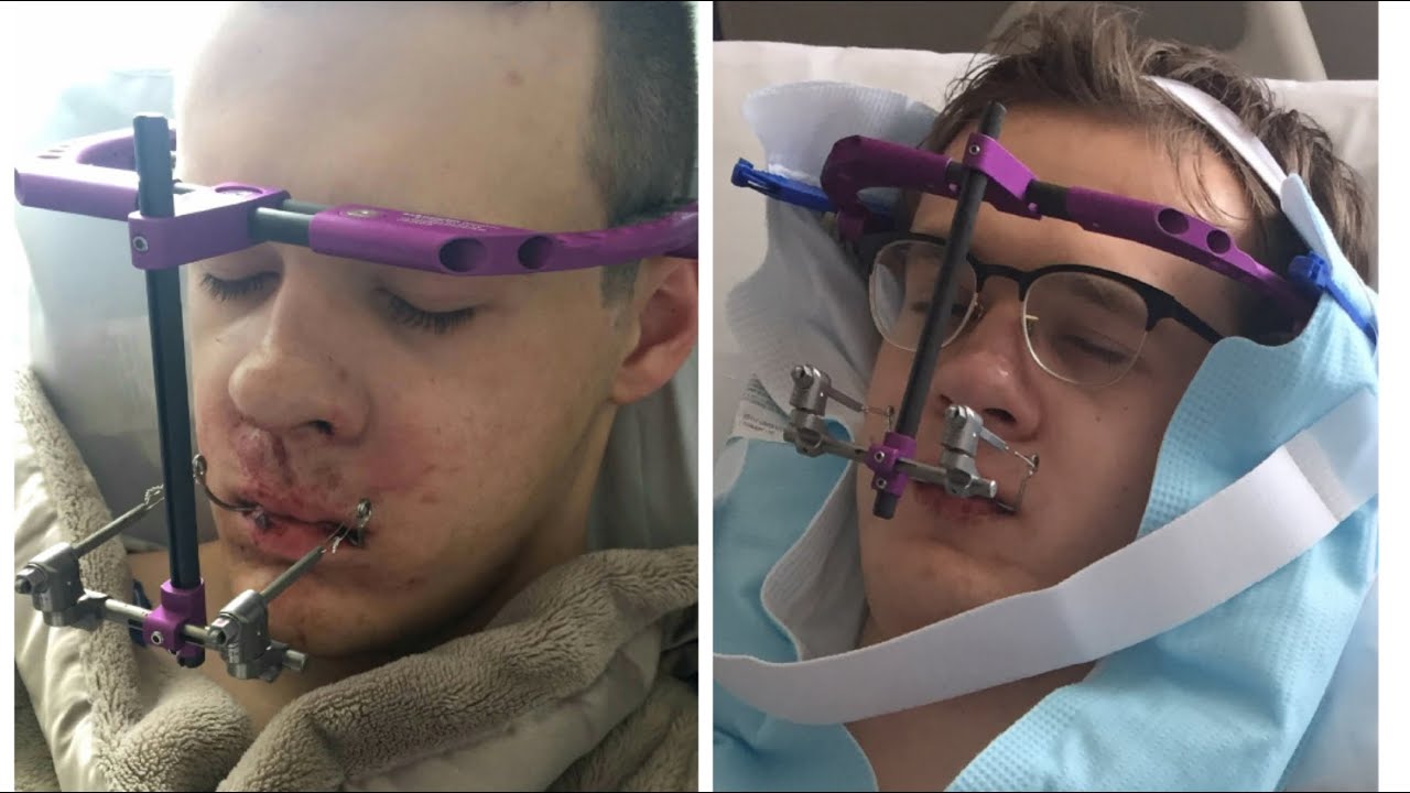 IDENTICAL TWINS HAVE JAW SURGERY // Part 1 (High Lefort 1 Osteotomy + Distraction Osteogenesis)