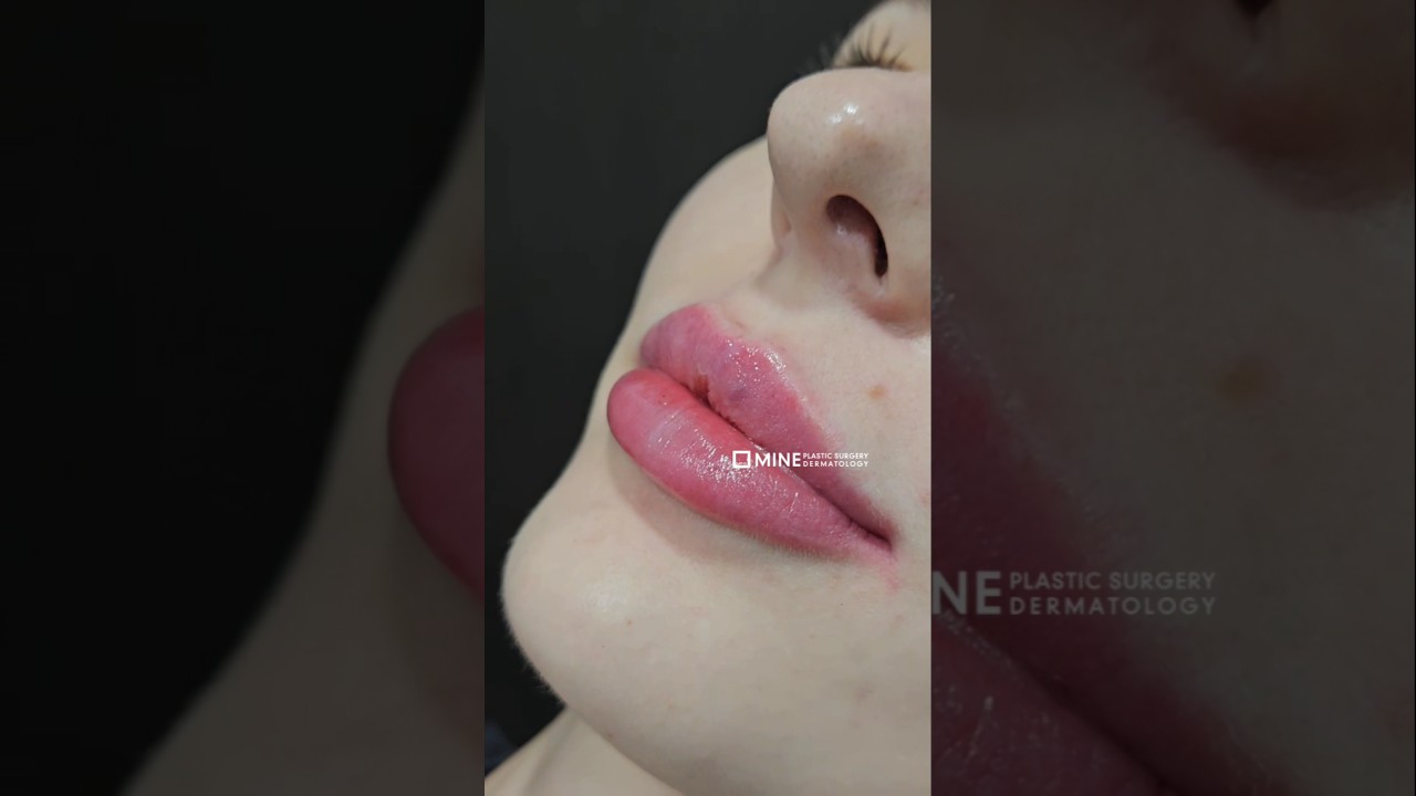Natural lip filler before and after #lipfiller