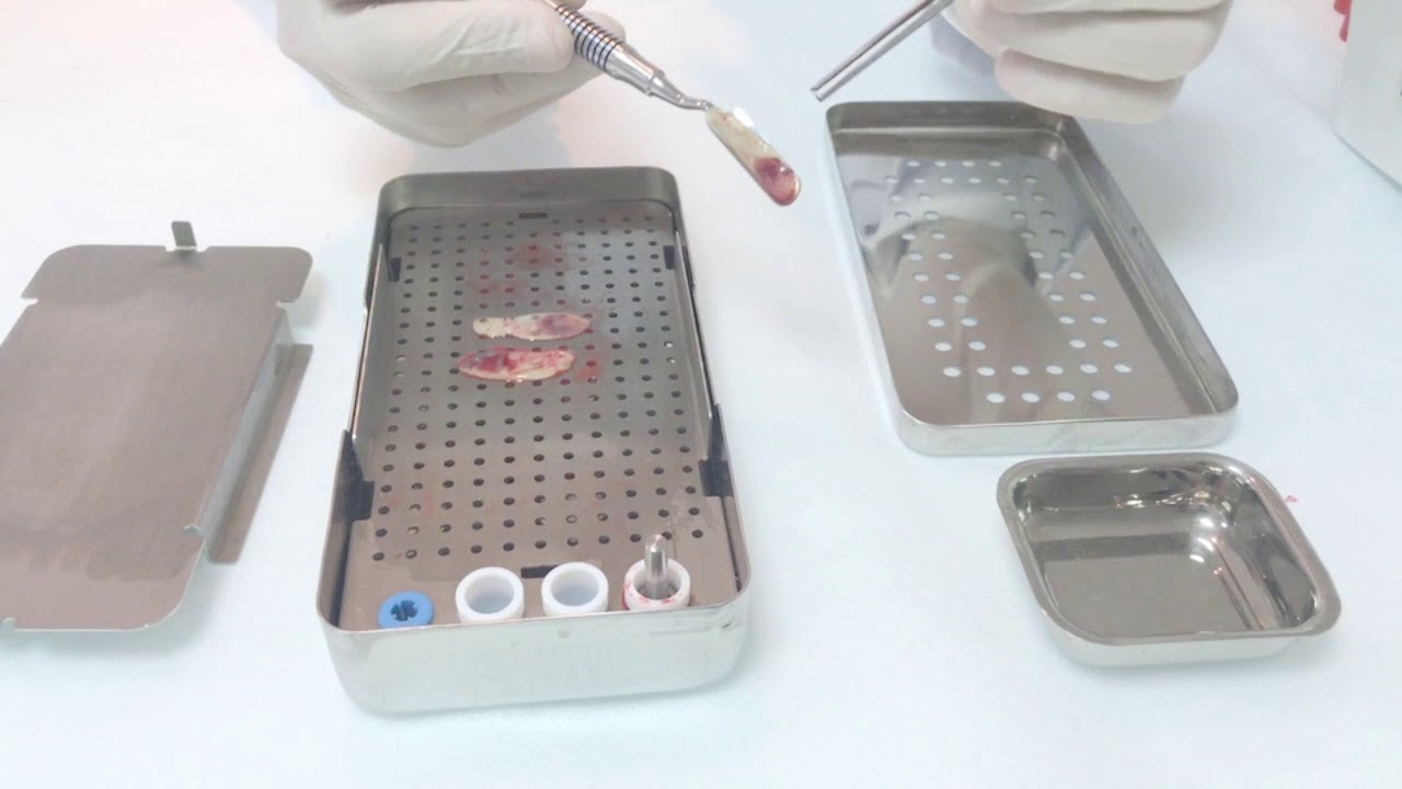 Fibrina rica em plaquetas / L-PRF process