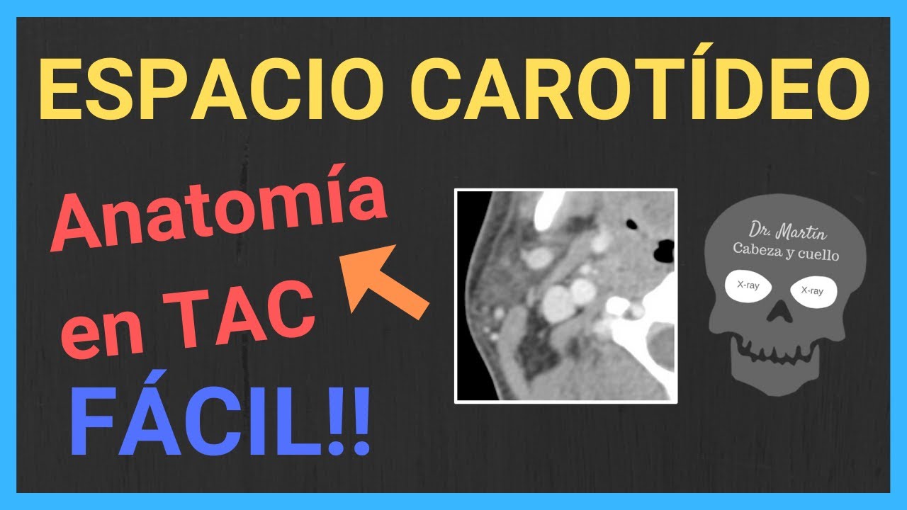 ✔ESPACIO CAROTÍDEO (Anatomía Radiológica)