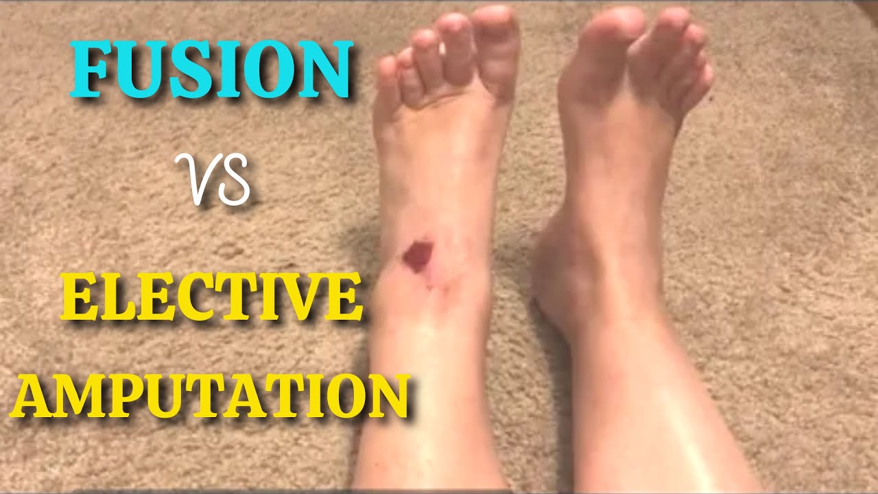 I Have Made My Decision. Fusion Vs Elective Amputation. #21