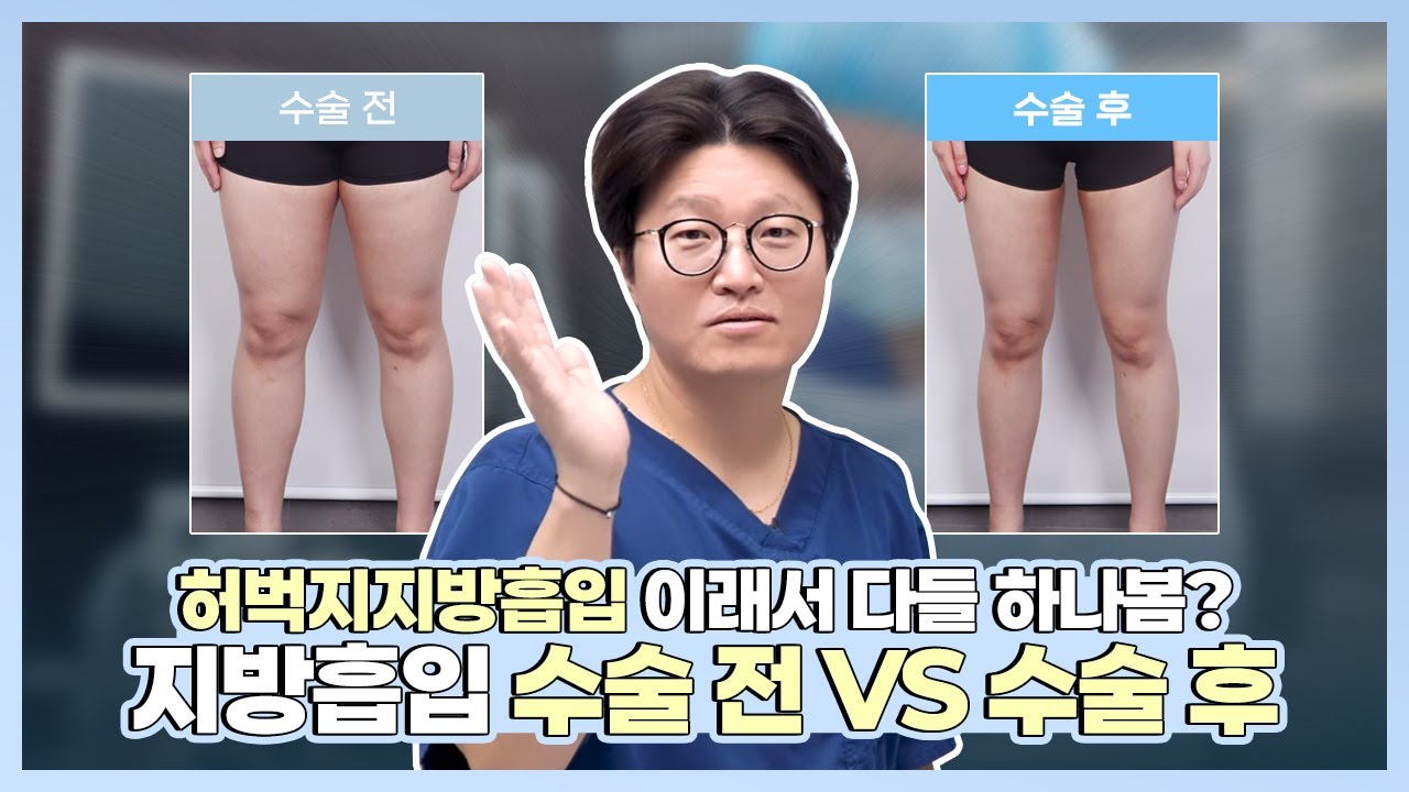 허벅지안쪽만 했을 뿐인데 이렇게 달라집니다❗️❗️ #허벅지지방흡입전후 #지방흡입후기