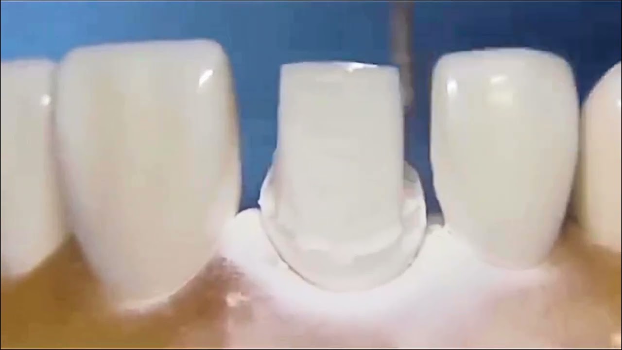 Anterior Crown Preparation (Step-by-Step)| Dr.Dentique-hub 