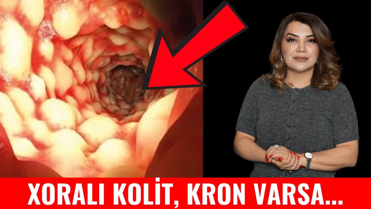 Xoralı kolit kron xəstəliyi tamamilə sağalır?