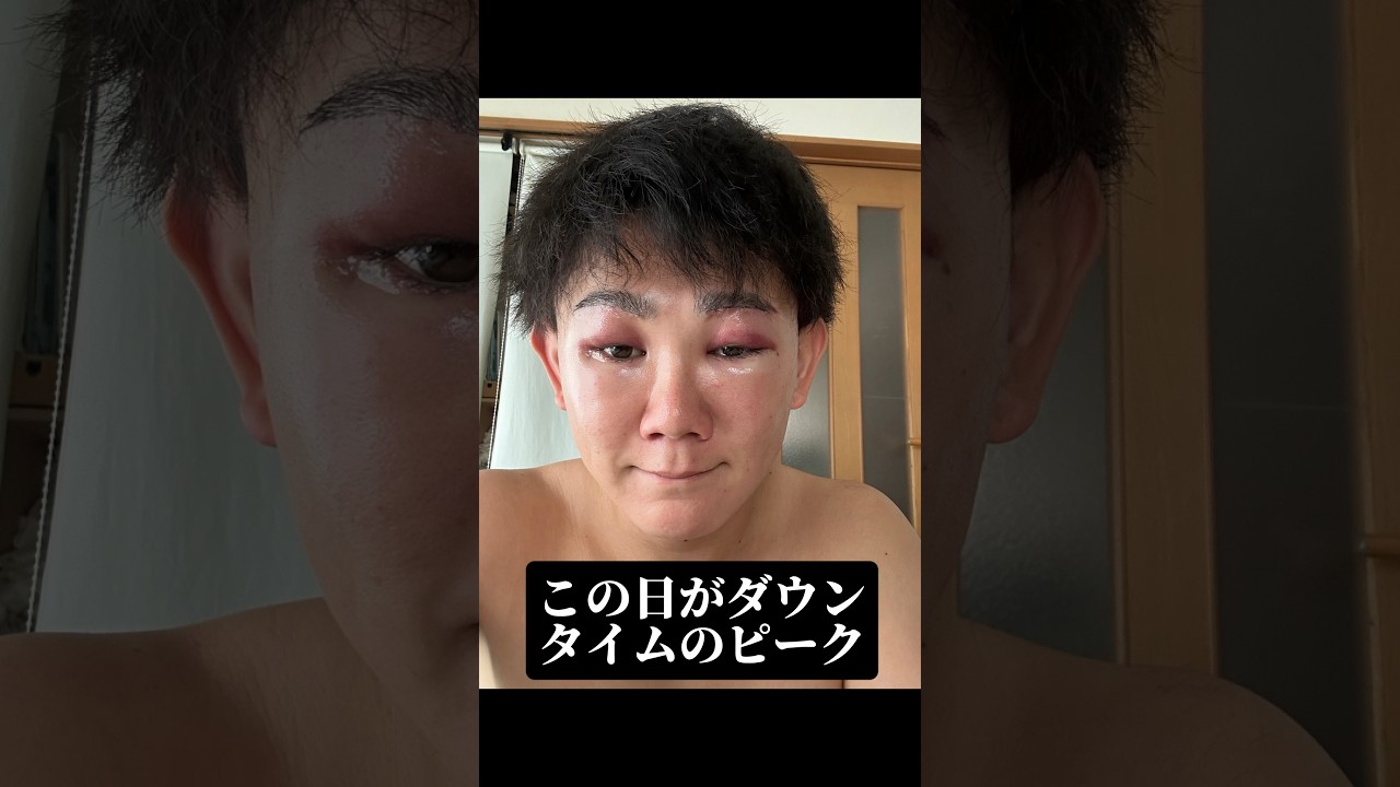 壮絶ダウンタイムを全て公開☆ #眉下切開 #眉下リフト #ハムラ法