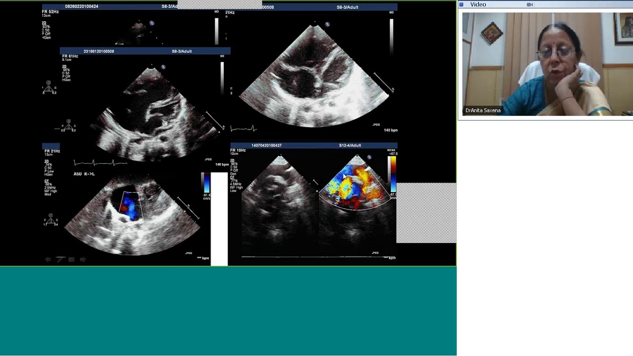 Pedicardio classes on Tricks and traps in CHD echoes by Dr Anita Saxena