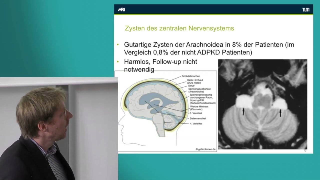 Leberzysten bei ADPKD - Dr. Christoph Schmaderer