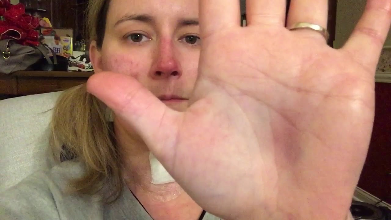 36 hours post-op 2 level cervical artificial disc replacement - Prestige LP