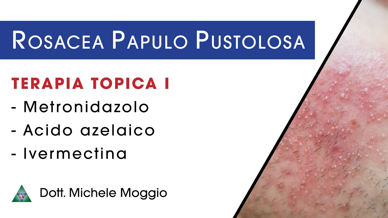 ROSACEA PAPULO PUSTOLOSA - Terapia Topica | dott. Michele Moggio