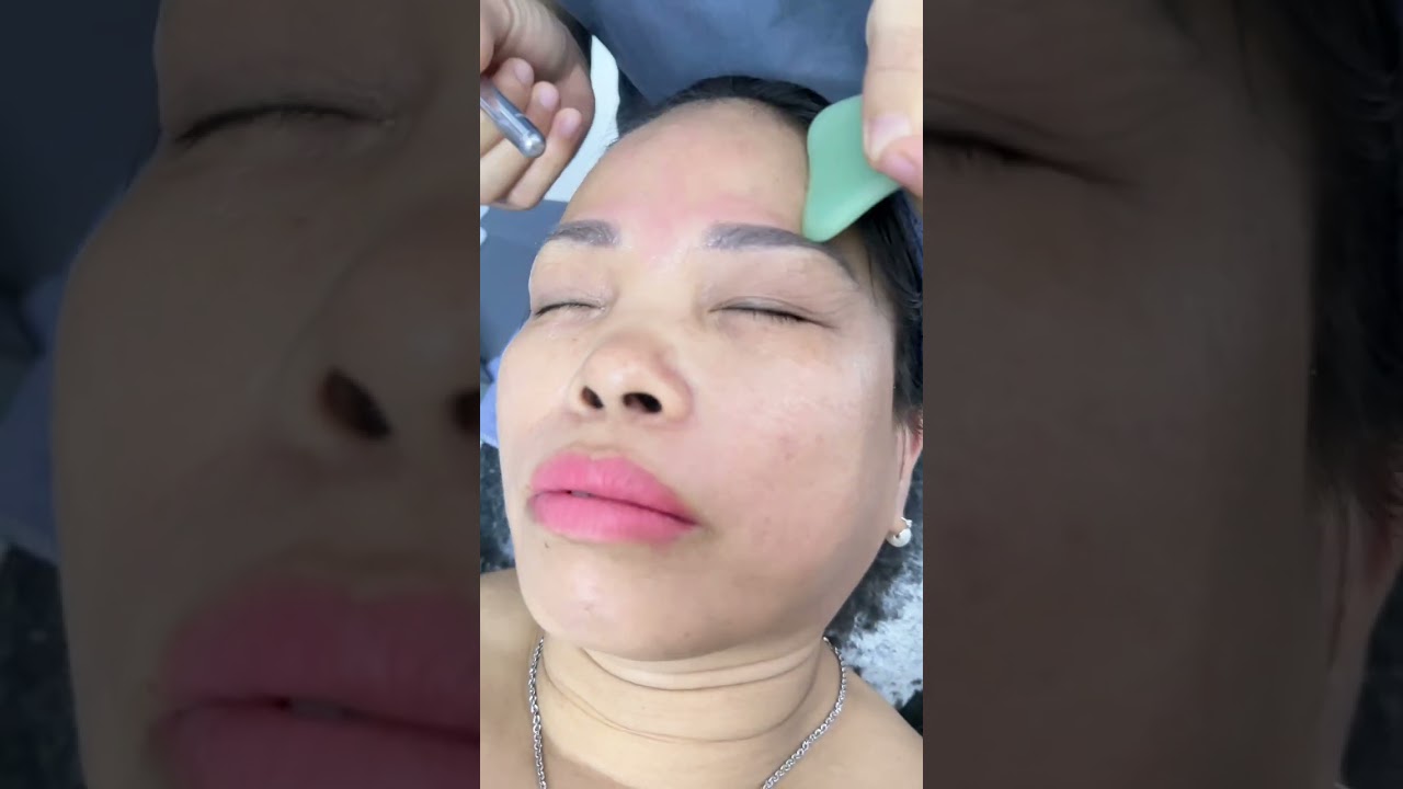Xoá nhăn trẻ hoá cho U50