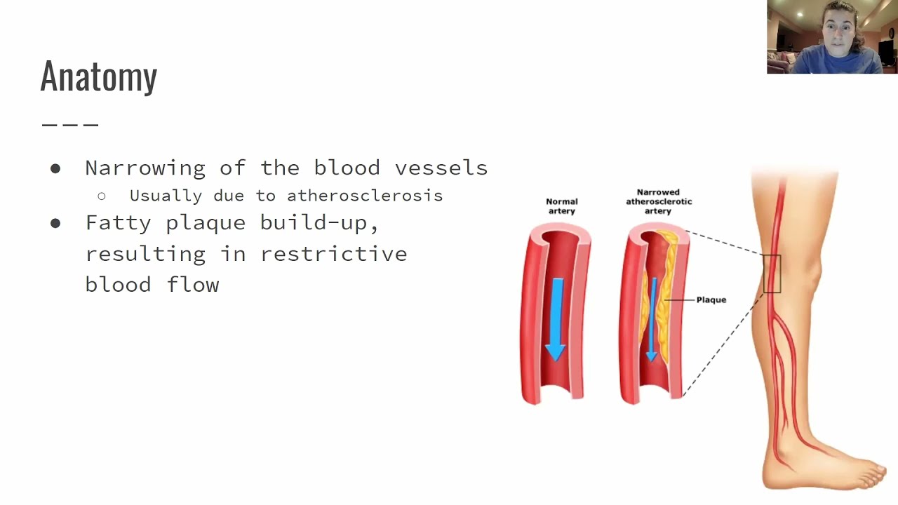 Peripheral Vascular Disease - NPTE-PTA Board Prep
