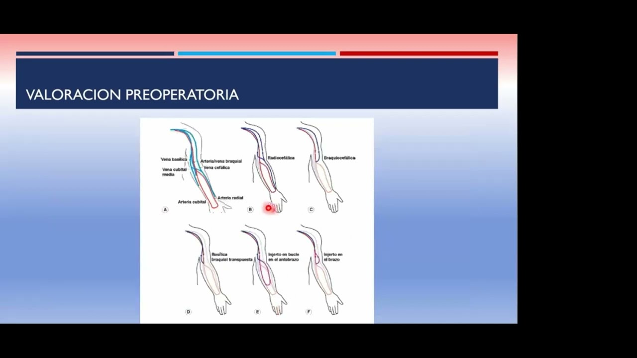 Accesos Vasculares