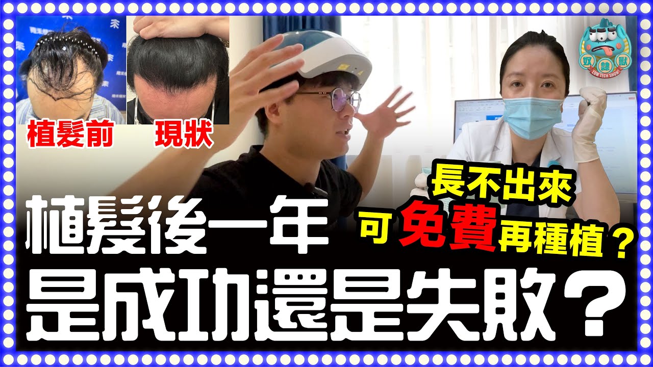 [實錄] 植髮一年了！是成功還是失敗？長不出來可免費再種植？
