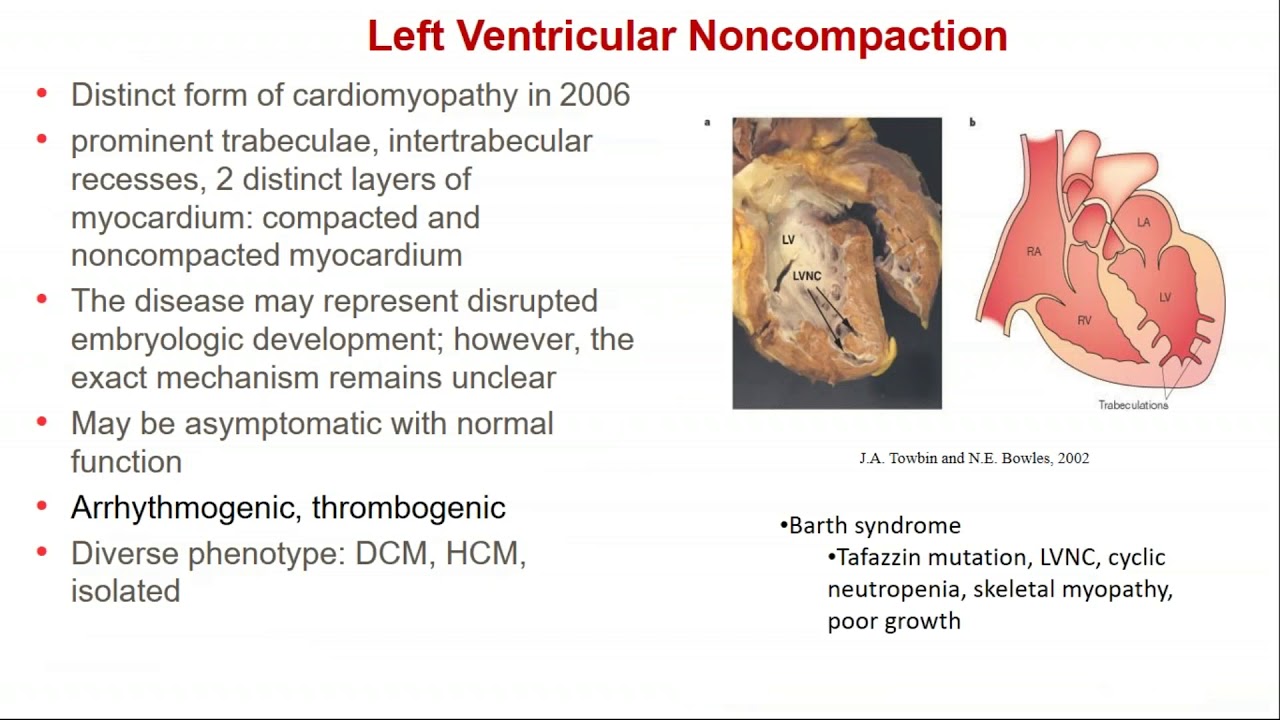 Updates in Medical Management in Pediatric Cardiomyopathy