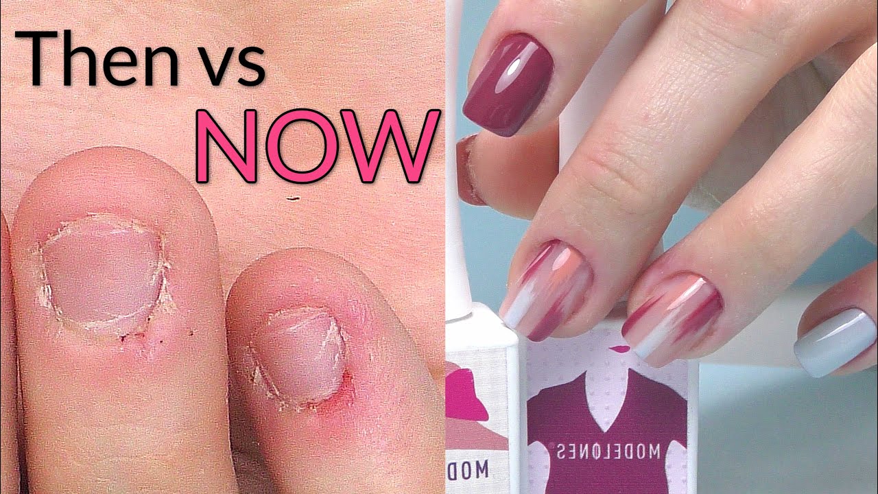 Short Bitten Nails Transformation Acrylic Fill & Update