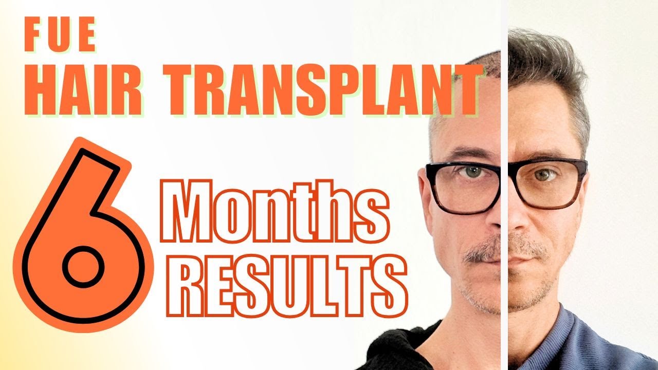 Hair Transplant in Turkey: Expectations Vs Results 6 Months | Cosmedica FUE