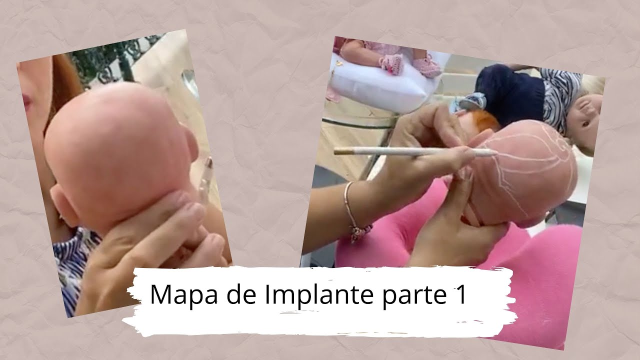 Mapa Simples  de Implante- Rejane dos Anjos