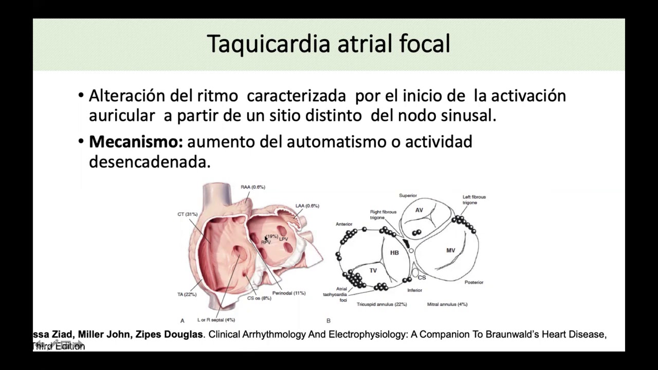 Taquiarritmias de QRS Estrecho
