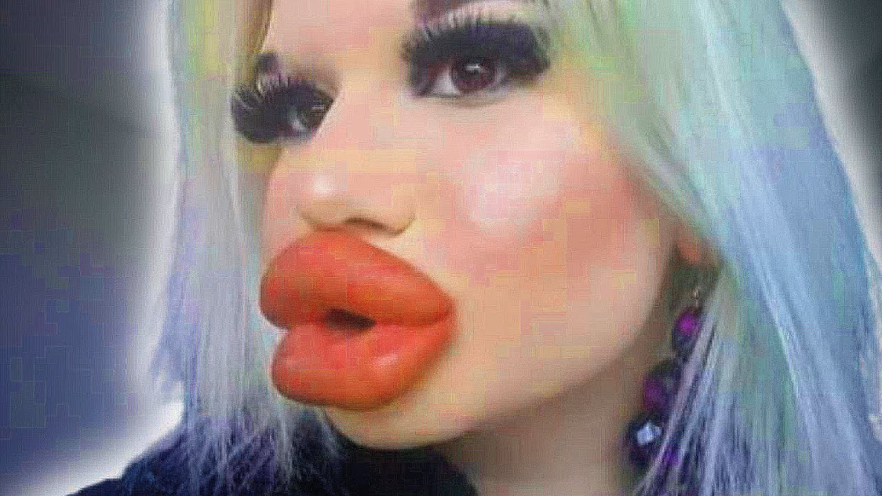 Why I Want The World's Biggest Lips - The Positivity Fix