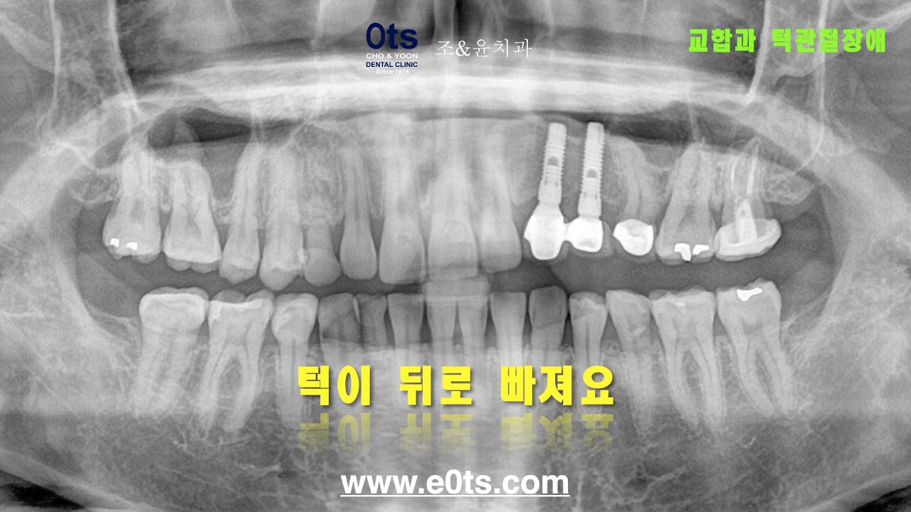 턱이 뒤로 빠져요 교합과 턱관절 턱관절장애
