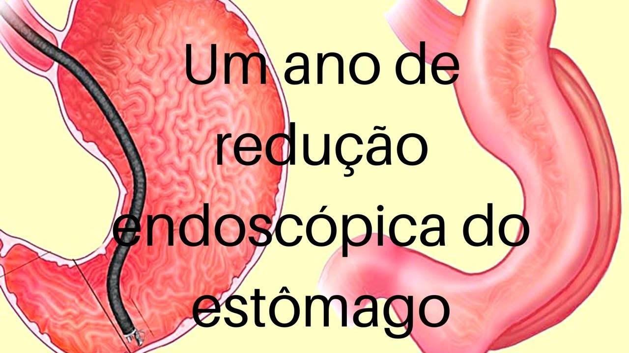 Um ano de gastroplastia endoscópica