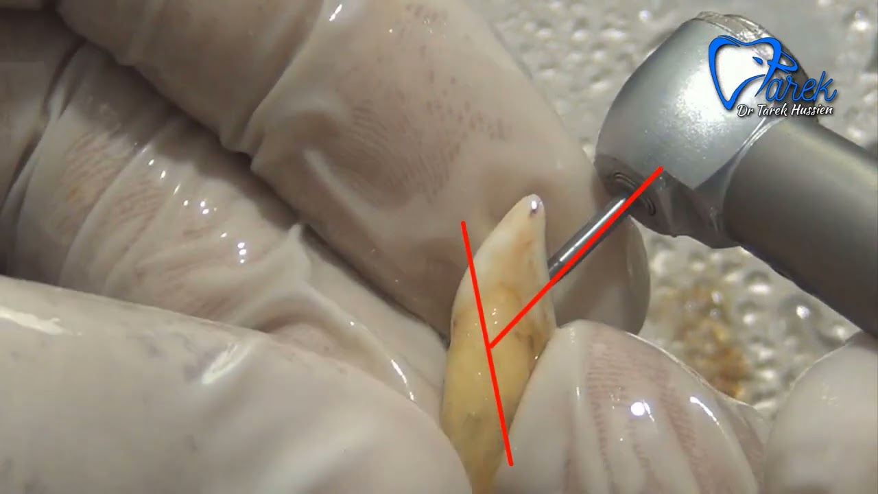 Access opening of maxillary central incisor | Dr Tarek Hussien