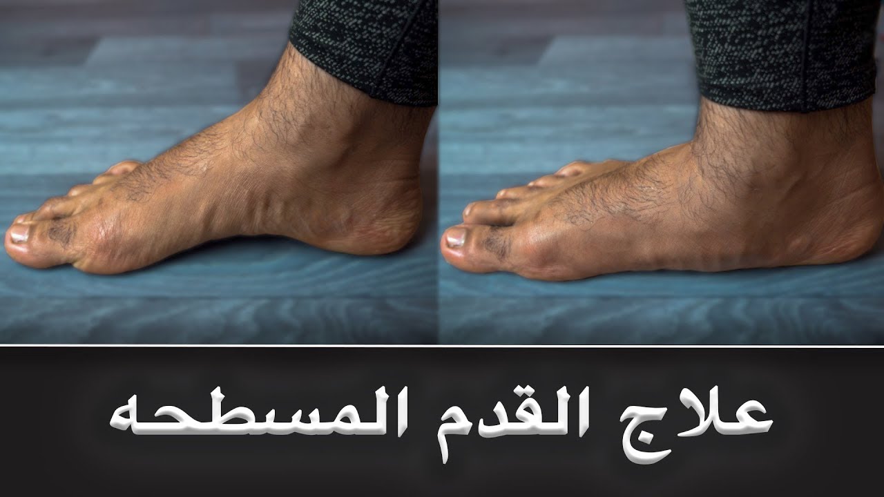 3 خطوات لحل مشكلة القدم المسطحة..!!