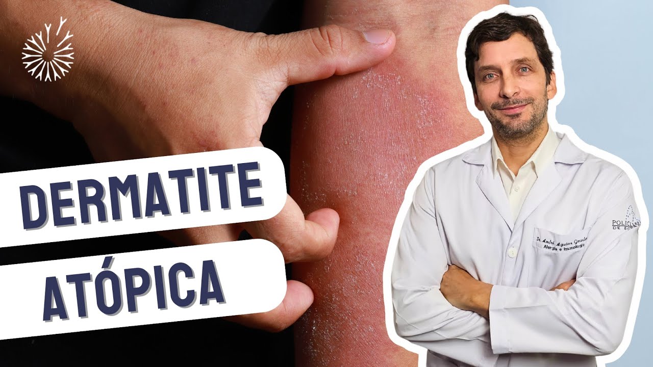 DERMATITE ATÓPICA . Médico orienta diagnóstico e tratamento. #dermatiteatopica #dermatite #coceira