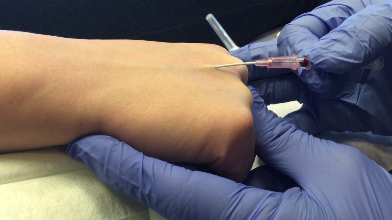 Easier IV Placement