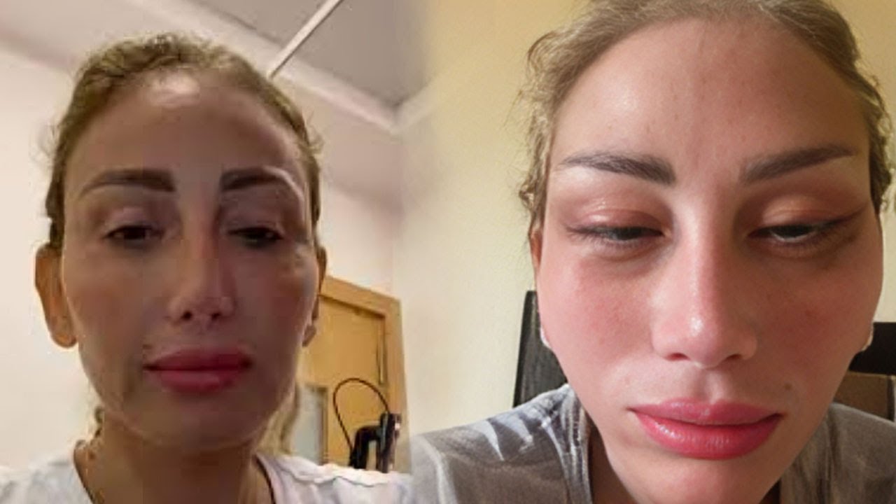 بقيت شبه الشــ ـيـ ـطـ ــان ووشى باظ بسبب دكتور تجميل فاااشل ماذا حـ ـدث  للأعلاميه ريهام سعيد