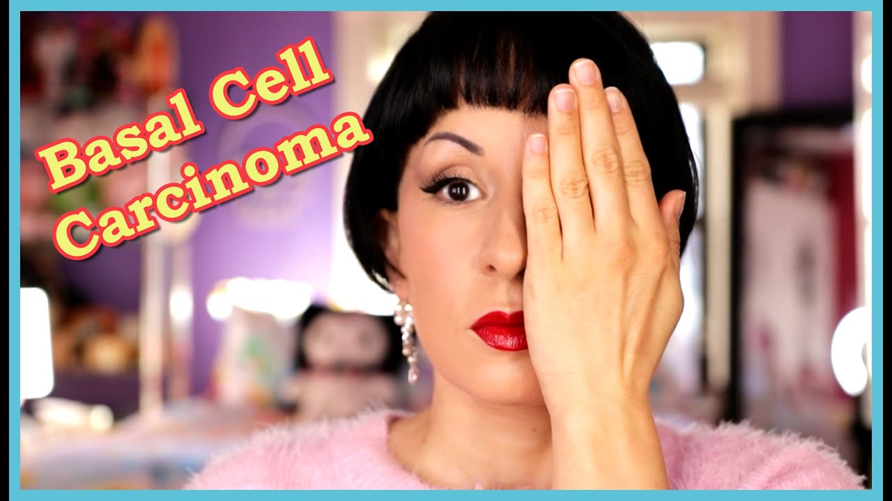 I Had Skin Cancer!  Mohs Surgery for Basal Cell Carcinoma and What to Expect.