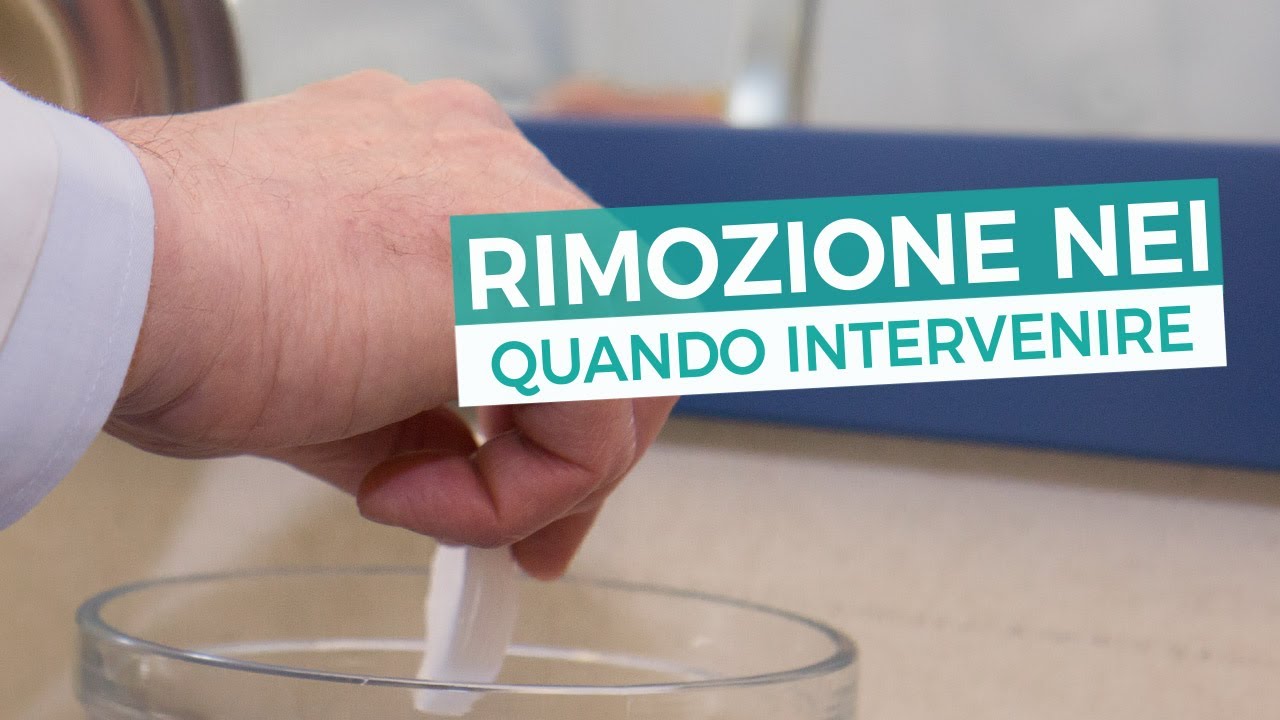 Rimozione nei: quando si deve intervenire?