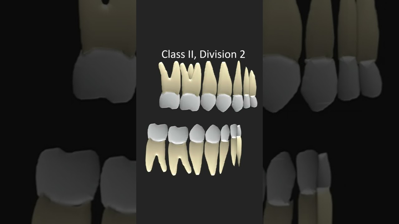 Angles Classification of Malocclusion #shorts #dentistry #orthodontics