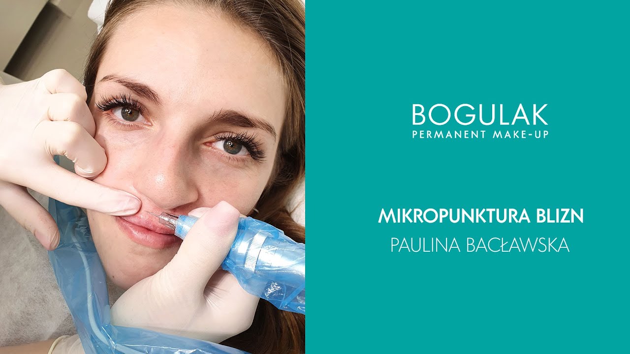 Mikropunktura blizny po rozszczepie wargi - Paulina Bacławska