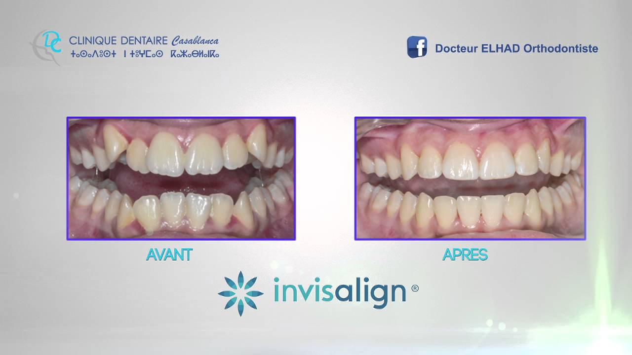 Cas Clinique | INVISALIGN