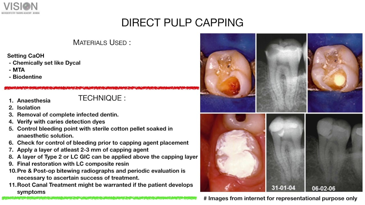 Management of OPEN APEX Cases Webinar for Endohaveli