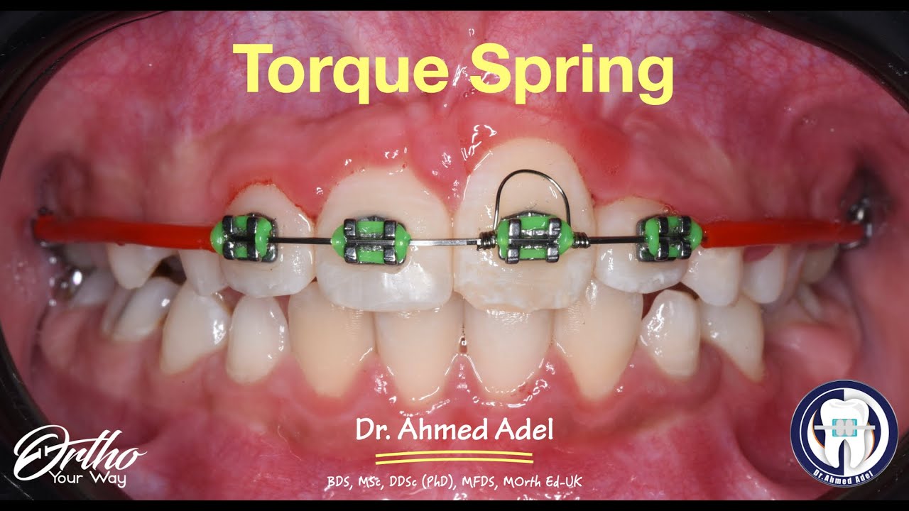 Torque spring of upper central incisor step by step by dr ahmed adel orthodontics