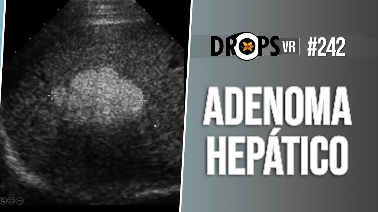 ADENOMA HEPÁTICO - O QUE É E COMO SE APRESENTA NA IMAGEM